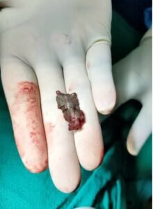 बम ब्लास्ट की चपेट में आया  बच्चा, स्पाइनल कॉर्ड डैमेज, रिम्स में हुआ सफल ऑपरेशन