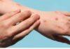 Monkey Pox अलर्ट: रिम्स में 10 और जिला अस्पतालों में 5 बेड रिजर्व, सैंपलिंग के निर्देश