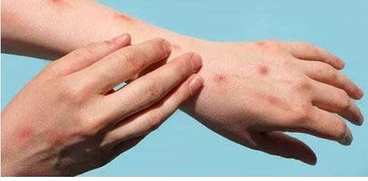 11072 Monkey Pox अलर्ट: रिम्स में 10 और जिला अस्पतालों में 5 बेड रिजर्व, सैंपलिंग के निर्देश