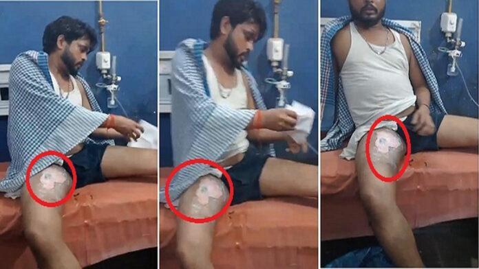 जेब में मोबाइल रखा है तो हो जाएं सावधान! ब्लास्ट में युवक का पैर झुलसा