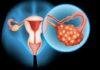 Health News: बच्चेदानी में गांठ (फाइब्रॉइड) के ये 4 लक्षण बिल्कुल न करें नजरअंदाज