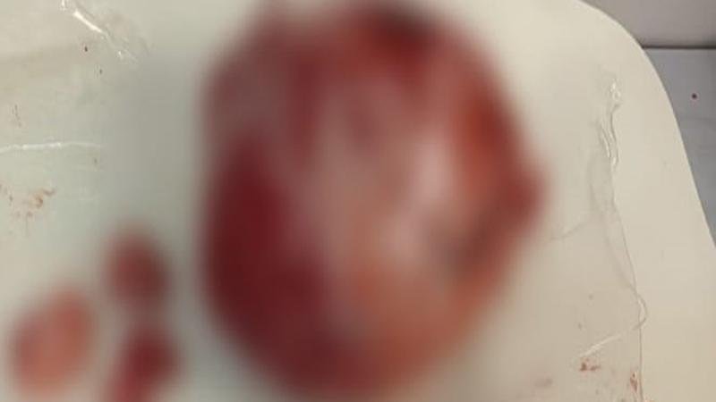 बच्चेदानी में गांठ के बावजूद मां बनने की उम्मीद जगी